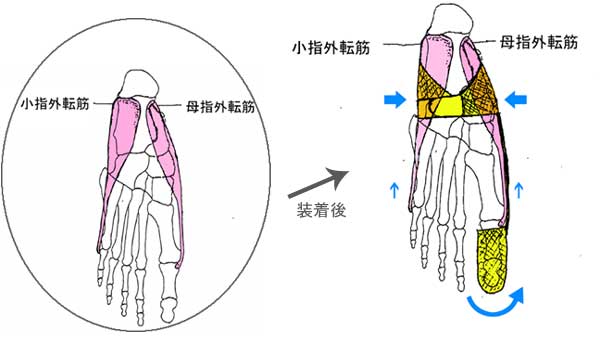 外反母趾 病院 治療 サポーター テーピング 予防矯正 痛みをなくします